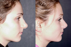 Rhinoplasty