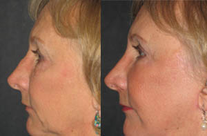 Rhinoplasty