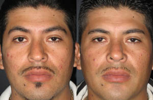 Rhinoplasty