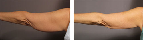 Smart Liposuction