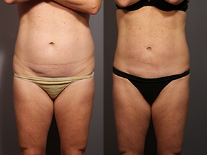 Smart Liposuction