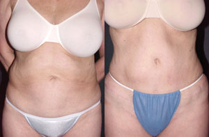 Tummy tuck
