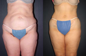 Tummy tuck