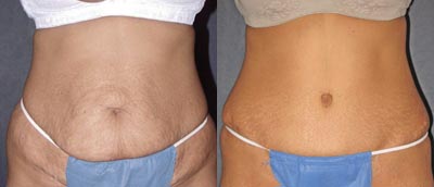 Tummy tuck
