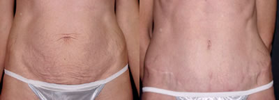 Tummy tuck