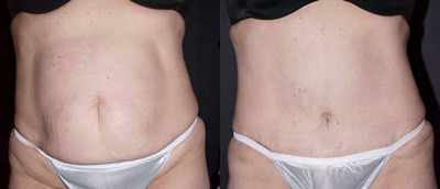 Tummy tuck