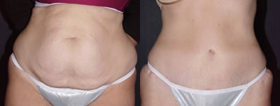Tummy tuck